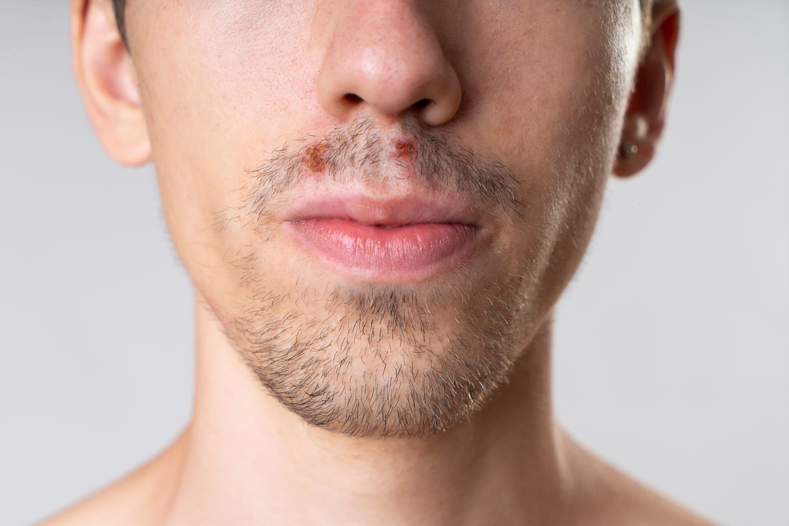 man's face with meth sores