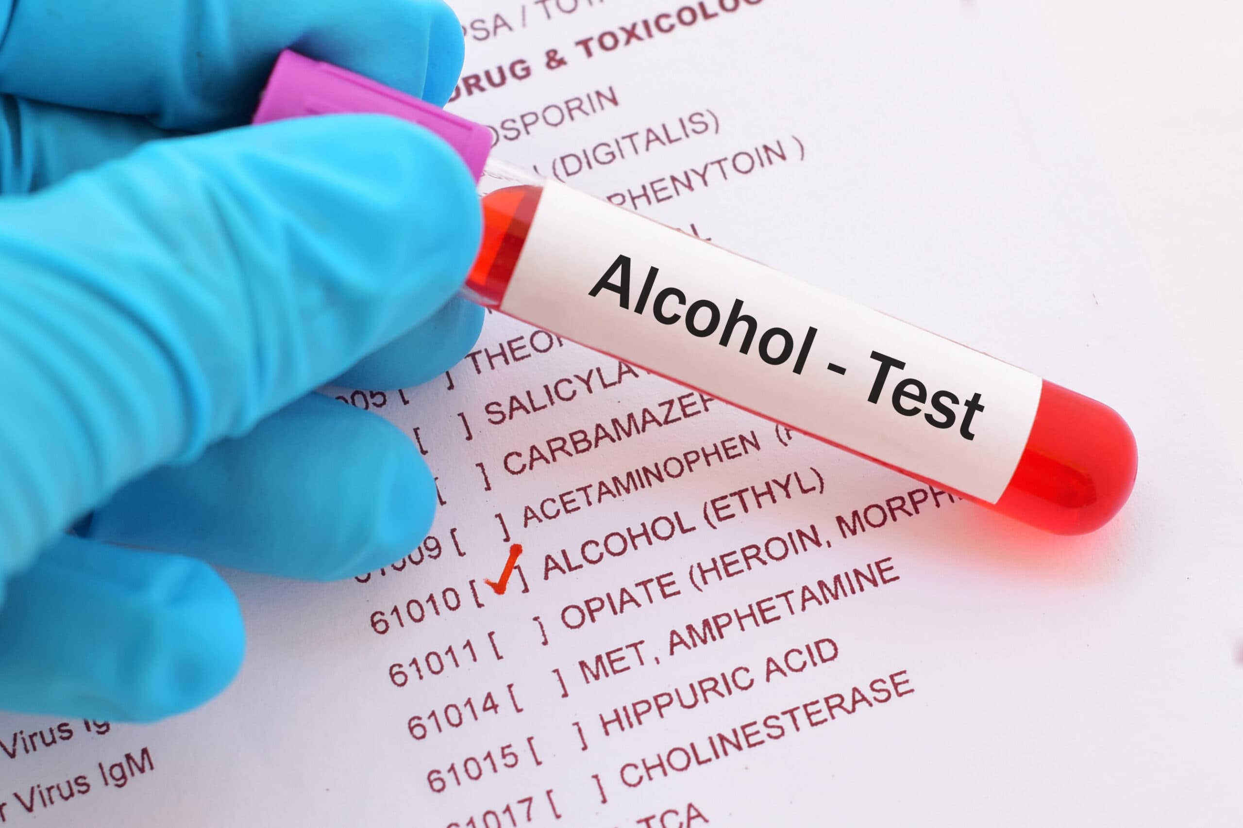 alcohol blood test lab