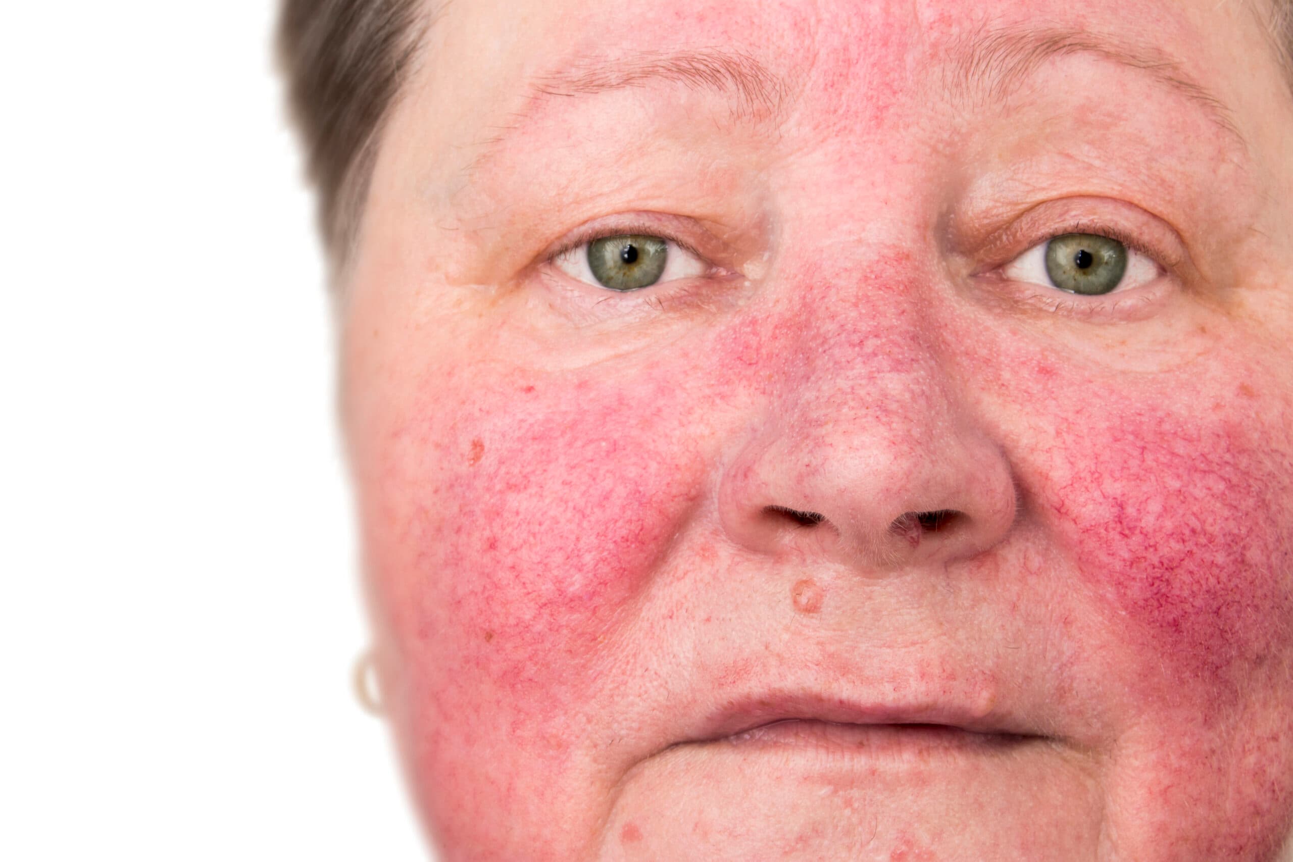 older woman alcoholic nose rosacea