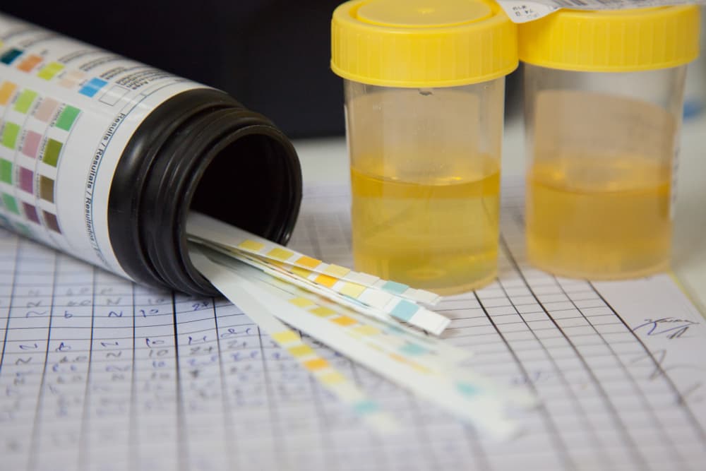 urine test strips and urine