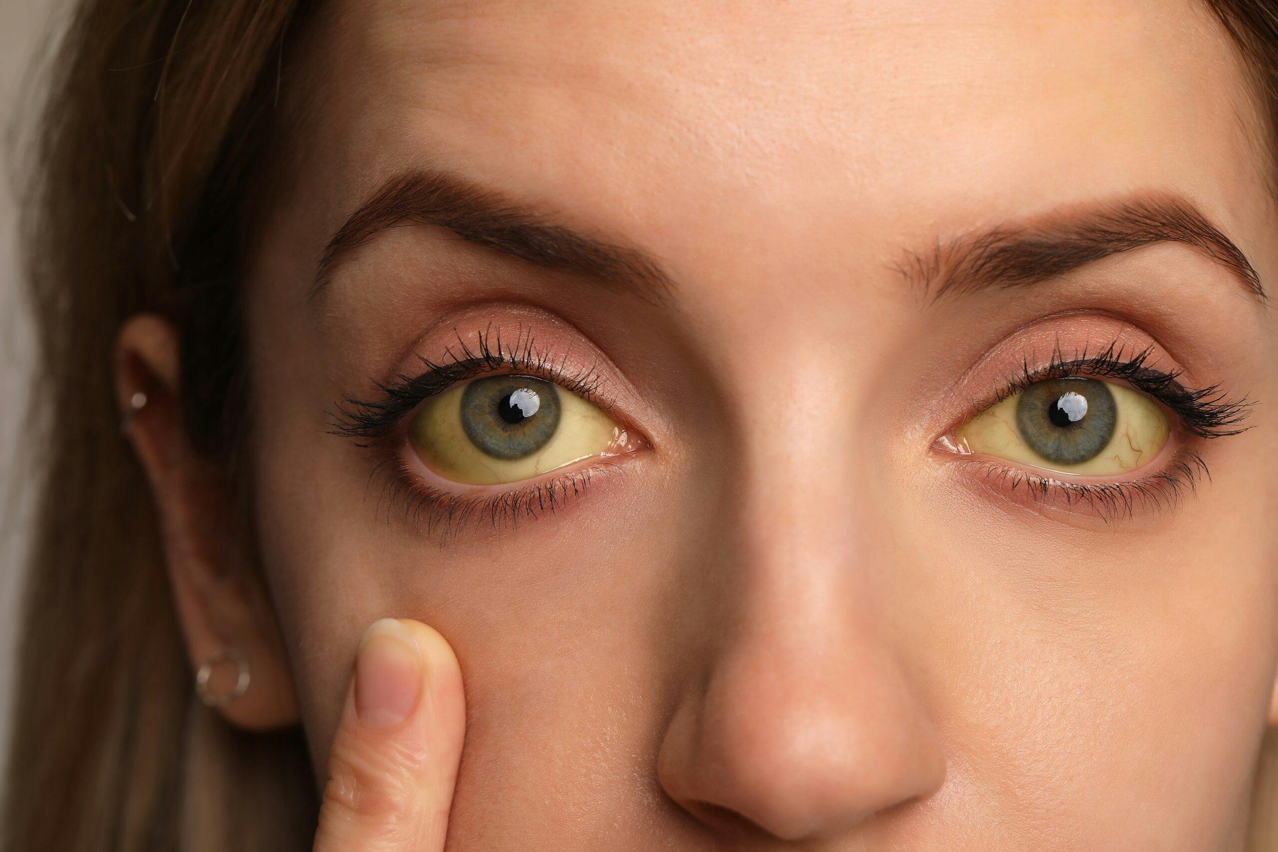 Doctor, doctor: What's causing the yellow streaks in my eyes?, Health &  wellbeing