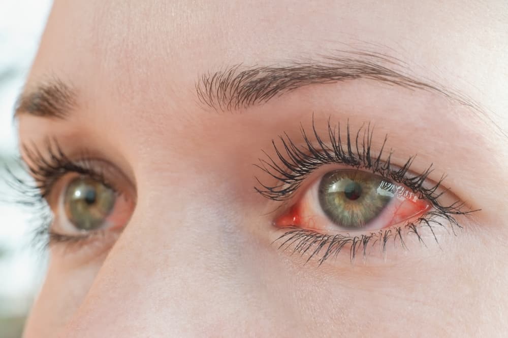 woman with bloodshot eyes from drinking