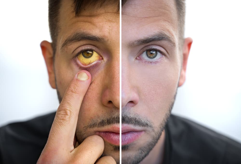 Yellow Eyes: Causes, Symptoms, And Treatment