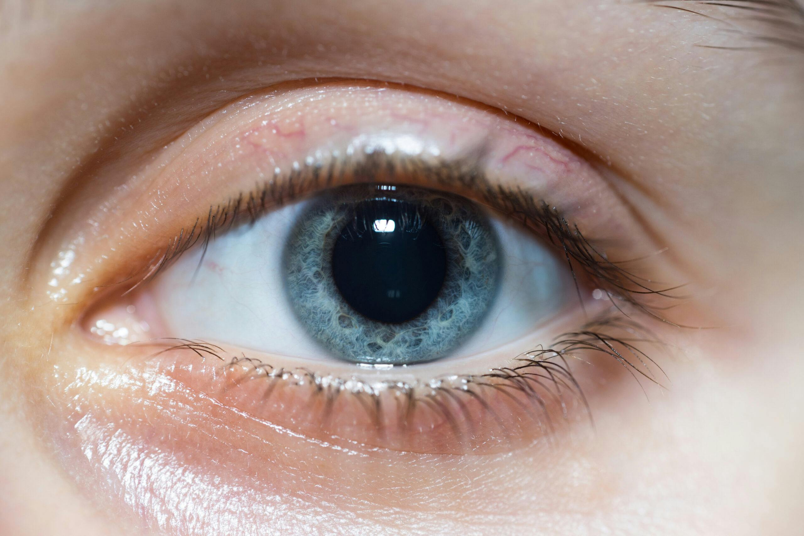 blue dilated pupil eye
