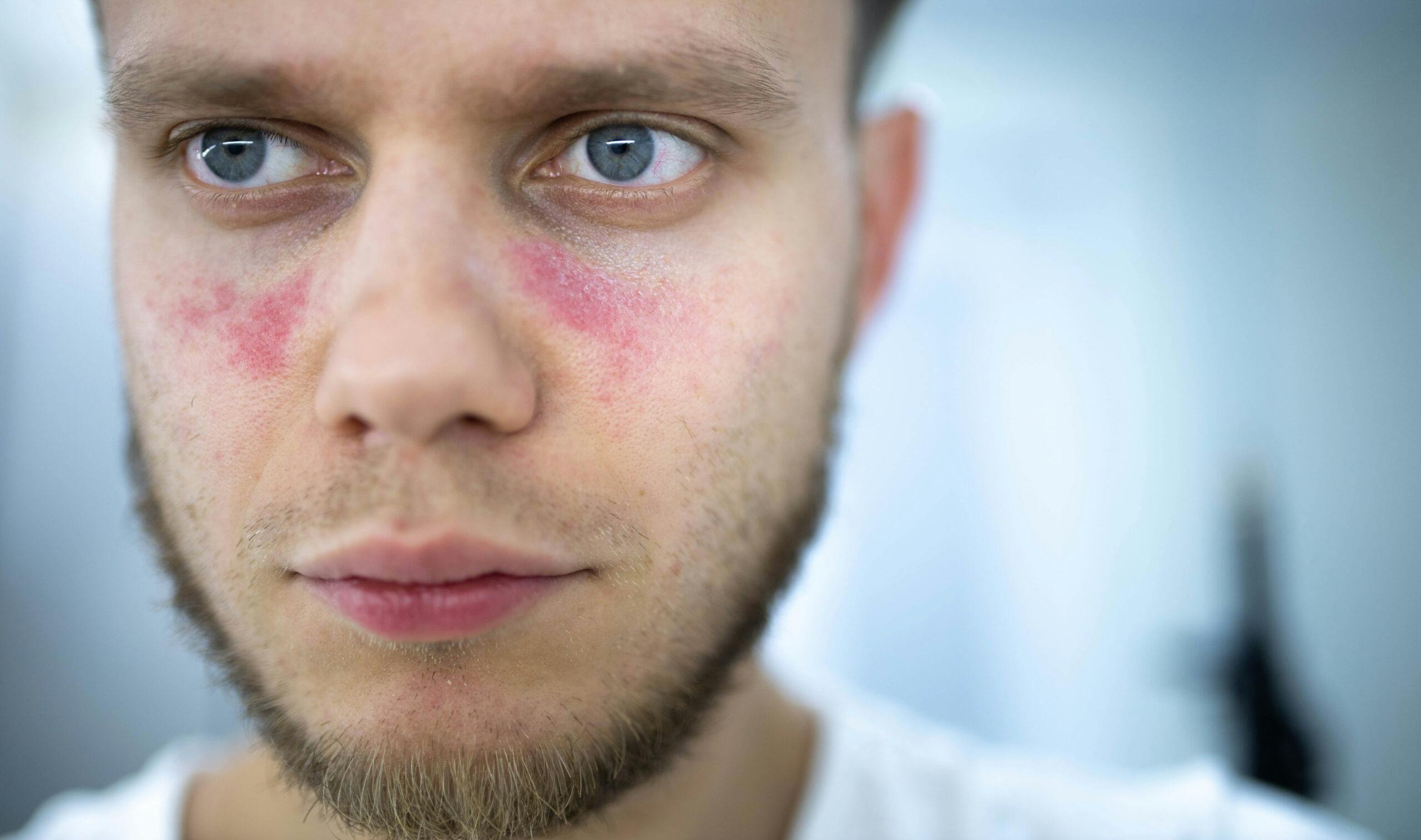 young man with red face from drinking alcohol