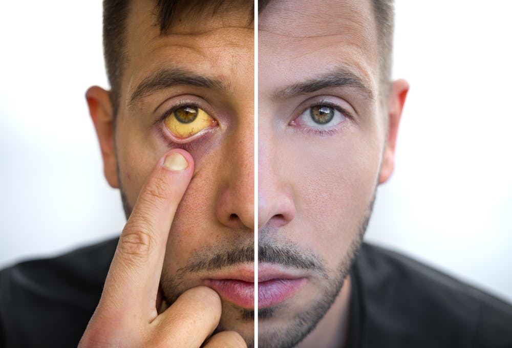 man with yellow eyes hepatitis