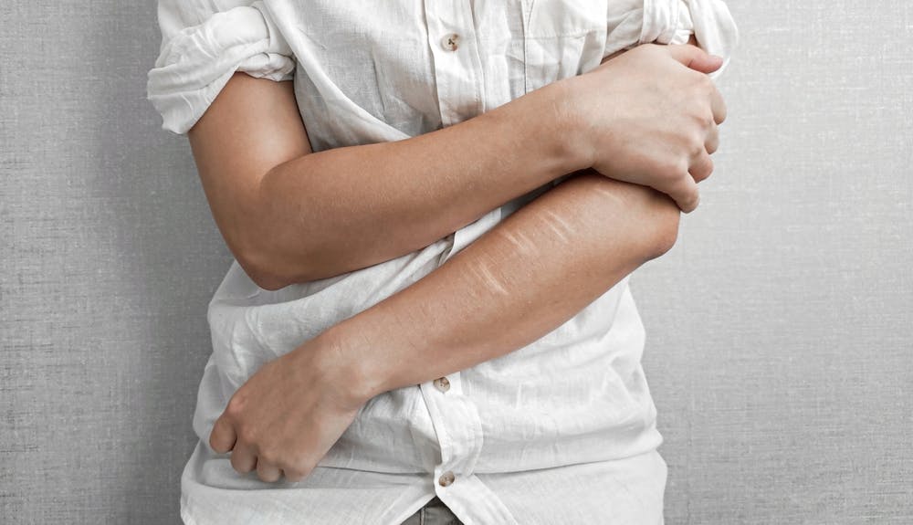self-harm scars on arm